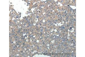 Immunohistochemistry of Human breast cancer using PVALB Polyclonal Antibody at dilution of 1:20