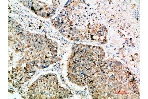 Immunohistochemical analysis of paraffin-embedded human-lung-cancer, antibody was diluted at 1:200 (LAMP3 antibody  (AA 261-310))