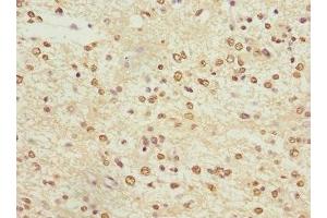 Immunohistochemistry of paraffin-embedded human glioma using ABIN7163952 at dilution of 1:100 (KCNA3 antibody  (AA 486-575))