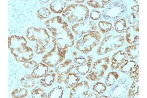 Formalin-fixed, paraffin-embedded human Renal Cell Carcinoma stained with Laminin Monoclonal Antibody (SPM193). (Laminin gamma 1 antibody)