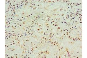 Immunohistochemistry of paraffin-embedded human breast cancer using ABIN7144000 at dilution of 1:100 (Aminoacylase 1 antibody  (AA 1-408))