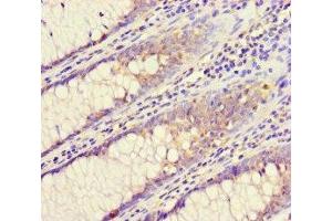 Immunohistochemistry of paraffin-embedded human colon cancer using ABIN7147525 at dilution of 1:100 (CHMP4C antibody  (AA 1-233))