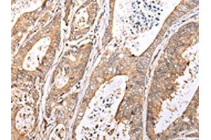 The image on the left is immunohistochemistry of paraffin-embedded Human colorectal cancer tissue using ABIN7193077(XKR7 Antibody) at dilution 1/20, on the right is treated with synthetic peptide. (XKR7 antibody)
