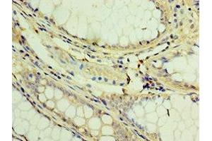 Immunohistochemistry of paraffin-embedded human colon cancer using ABIN7173394 at dilution of 1:100 (TGS1 antibody  (AA 714-853))