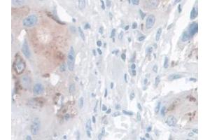 DAB staining on IHC-P; Samples: Human Breast cancer Tissue (Kallikrein 14 antibody  (AA 36-267))