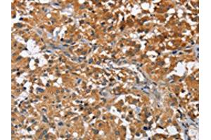 The image on the left is immunohistochemistry of paraffin-embedded Human thyroid cancer tissue using ABIN7128585(ATP1B2 Antibody) at dilution 1/30, on the right is treated with fusion protein.