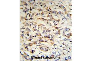 CPN2 Antibody (RB18703) IHC analysis in formalin fixed and paraffin embedded human breast carcinoma tissue followed by peroxidase conjugation of the secondary antibody and DAB staining.