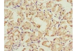 Immunohistochemistry of paraffin-embedded human gastric cancer using ABIN7142206 at dilution of 1:100 (PSMD12 antibody  (Regulatory Subunit 12))