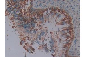 DAB staining on IHC-P; Samples: Human Lung cancer Tissue (SERPINB3 antibody  (AA 1-210))