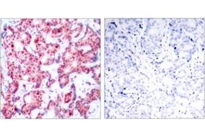 Immunohistochemistry analysis of paraffin-embedded human breast carcinoma, using GATA1 (Phospho-Ser142) Antibody. (GATA1 antibody  (pSer142))