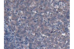 IHC-P analysis of Human Endometrial cancer Tissue, with DAB staining.