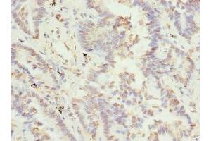 Immunohistochemistry of paraffin-embedded human lung cancer using ABIN7171838 at dilution of 1:100 (TSSK3 antibody  (AA 1-268))