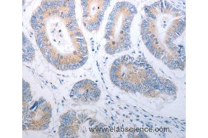 Immunohistochemistry of Human colon cancer using PAK1 Polyclonal Antibody at dilution of 1:40