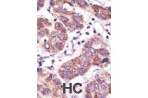 Formalin-fixed and paraffin-embedded human cancer tissue reacted with the primary antibody, which was peroxidase-conjugated to the secondary antibody, followed by DAB staining. (USP3 antibody  (N-Term))