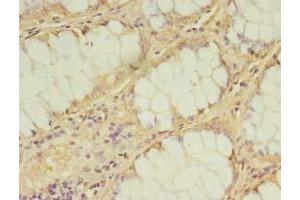Immunohistochemistry of paraffin-embedded human breast cancer using ABIN7157126 at dilution of 1:100 (IPP Isomerase 2 antibody  (AA 1-227))