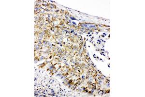 Anti-Prohibitin antibody, IHC(P) IHC(P): Human Lung Cancer Tissue (Prohibitin antibody  (C-Term))
