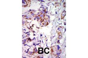 Formalin-fixed and paraffin-embedded human cancer tissue reacted with GRK6 polyclonal antibody  , which was peroxidase-conjugated to the secondary antibody, followed by DAB staining . (GRK6 antibody  (C-Term))