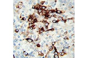 VIM antibody immunohistochemistry analysis in formalin fixed and paraffin embedded human prostate tissue. (Vimentin antibody  (AA 152-181))