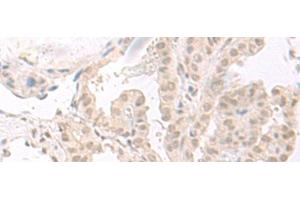 Immunohistochemistry of paraffin-embedded Human thyroid cancer tissue using HOOK2 Polyclonal Antibody at dilution of 1:30(x200) (HOOK2 antibody)