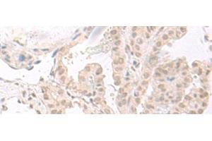 Immunohistochemistry of paraffin-embedded Human thyroid cancer tissue using HOOK2 Polyclonal Antibody at dilution of 1:30(x200)