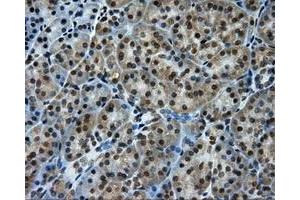 Immunohistochemical staining of paraffin-embedded Carcinoma of liver tissue using anti-PTPRE mouse monoclonal antibody.