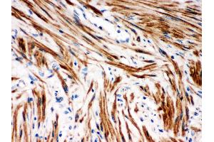 Anti- IKB beta Picoband antibody,IHC(P) IHC(P): Human Intestinal Cancer Tissue (NFKBIB antibody  (AA 56-237))