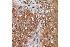 Immunohistochemical analysis of ALPK1 staining in human breast cancer formalin fixed paraffin embedded tissue section. (ALPK1 antibody  (N-Term))