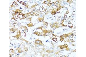 Immunohistochemistry of paraffin-embedded Human liver cancer using SERPINA3 Polyclonal Antibody at dilution of 1:100 (40x lens). (SERPINA3 antibody)
