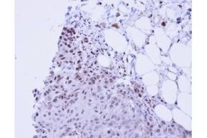 IHC-P Image Immunohistochemical analysis of paraffin-embedded Cal27 Xenograft, using SSRP1, antibody at 1:100 dilution. (SSRP1 antibody)