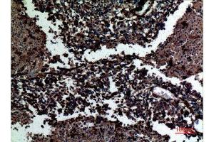 Immunohistochemistry (IHC) analysis of paraffin-embedded Human Lung Cancer, antibody was diluted at 1:100. (Galectin 3 antibody  (C-Term))