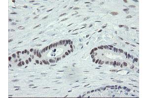 Immunohistochemical staining of paraffin-embedded Adenocarcinoma of Human colon tissue using anti-ZBED1 mouse monoclonal antibody. (ZBED1 antibody)