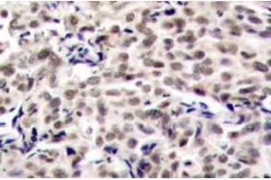 Immunohistochemistry (IHC) analyzes of CREB antibody in paraffin-embedded human breast carcinoma tissue. (CREB1 antibody)