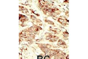 Formalin-fixed and paraffin-embedded human cancer tissue reacted with the primary antibody, which was peroxidase-conjugated to the secondary antibody, followed by DAB staining. (STK35 antibody  (AA 374-404))