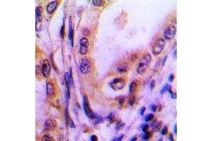 Immunohistochemical analysis of Thrombospondin 4 staining in human lung cancer formalin fixed paraffin embedded tissue section. (THBS4 antibody)