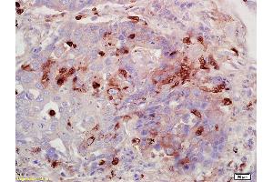 Formalin-fixed and paraffin embedded human lung carcinoma labeled with Anti-FUCA1/Alpha L fucosidase I Polyclonal Antibody, Unconjugated (ABIN682003) at 1:200 followed by conjugation to the secondary antibody and DAB staining.