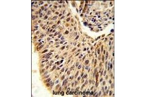 Formalin-fixed and paraffin-embedded human lung carcinoma reacted with GLIS1 Antibody (N-term), which was peroxidase-conjugated to the secondary antibody, followed by DAB staining. (GLIS1 antibody  (N-Term))