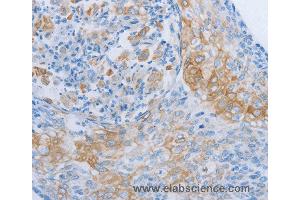 Immunohistochemistry of Human cervical cancer using ADRB3 Polyclonal Antibody at dilution of 1:60