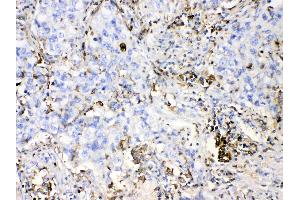 DHODH was detected in paraffin-embedded sections of human lung cancer tissues using rabbit anti- DHODH Antigen Affinity purified polyclonal antibody (Catalog # ) at 1 µg/mL.