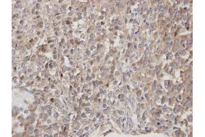 IHC-P Image Immunohistochemical analysis of paraffin-embedded human lung cancer, using DOCK 180 , antibody at 1:100 dilution. (DOCK1 antibody  (C-Term))