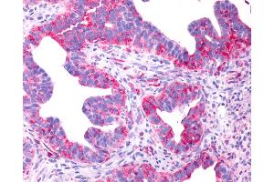 Anti-P2RY8 / P2Y8 antibody IHC of human Ovary, Carcinoma. (P2RY8 antibody  (Cytoplasmic Domain))