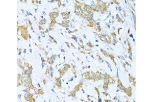Immunohistochemistry of paraffin-embedded Human gastric cancer using KLHL42 Polyclonal Antibody at dilution of 1:100 (40x lens).