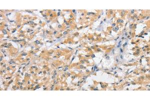 Immunohistochemistry of paraffin-embedded Human thyroid cancer using ATG10 Polyclonal Antibody at dilution of 1:60 (ATG10 antibody)