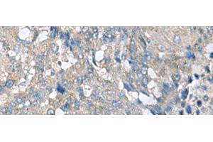 Immunohistochemistry of paraffin-embedded Human liver cancer tissue using HPCAL1 Polyclonal Antibody at dilution of 1:70(x200) (HPCAL1 antibody)