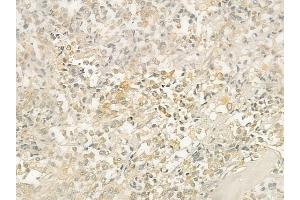 ABIN6254909 and ABIN6276368 at 1/100 staining human prostate carcinoma by IHC-P. (CD40 Ligand antibody  (Internal Region))