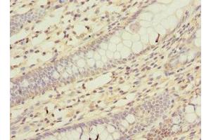 Immunohistochemistry of paraffin-embedded human colon cancer using ABIN7163978 at dilution of 1:100