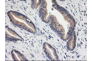 Immunohistochemical staining of paraffin-embedded Adenocarcinoma of Human colon tissue using anti-BAIAP2 mouse monoclonal antibody. (BAIAP2 antibody)