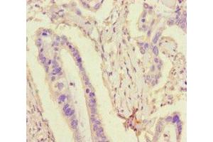 Immunohistochemistry of paraffin-embedded human pancreatic cancer using ABIN7173764 at dilution of 1:100