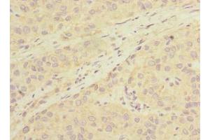 Immunohistochemistry of paraffin-embedded human liver cancer using ABIN7163378 at dilution of 1:100 (LHPP antibody  (AA 1-270))