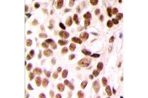 Immunohistochemical analysis of SUR2 staining in human breast cancer formalin fixed paraffin embedded tissue section. (ABCC9 antibody  (N-Term))
