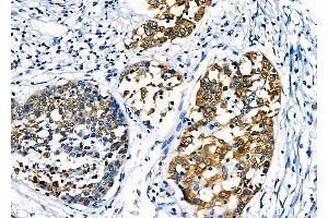ABIN6258195 and ABIN6276040 at 1/100 staining Human esophageal cancer by IHC-P.